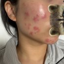 쿠스네일 | 피부 자격증 모델 후기와 피부염 | 국가 고시 | 피부 진정