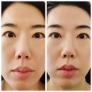 평택피부관리 샵이뻐져라 (#2뻐져라) 하이푸리프팅 후기 얼굴을 탱탱하게~