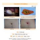 만성담낭염수술후기. 상복부 하복부가 너무 아파서 CT결과 담낭에 혹이 보여 수술이 필요하다고 생각했습니다. 이미지