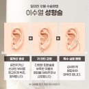 에스클래스성형외과의원 | 귀걸이 때문에 갈라진 귓불, 이수열 수술이 필요한 경우는