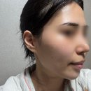 신사역 티타늄리프팅 60KJ 1주일 변화, 수부지도 볼패임 없이 속광 채운 찐후기
