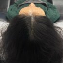 신의의원 | 두피탈모고민, 수술커버에 신의 스킬 보유하신 모두스칼프 진심 강추~!!