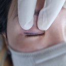 멍포유 | 연산동잔흔제거 15년묵은 아이라인 1회 제거 포유스튜디오 솔직후기