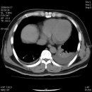 hemothorax/pleural effusion 환자의 조영전.후의 비교 영상 이미지