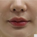 마노성형외과의원 | 인중축소술후기 무엇보다 과하지 않게 마무리해야 합니다.