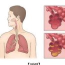 노란 가래 생기는 이유 가래 없애는법 삭히는법 빼는법 목가래 정리해 봄 이미지
