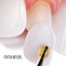 N.P치과기공소 | 유니시티치과 라미네이트 전 꼭 알아야 할 5가지