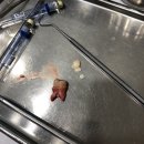 박경준치과의원 | 박경준치과의원 매복사랑니 발치후기