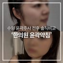 샘아쿠아라인 | 수원윤곽주사 얼굴라인관리 가격, 인계동 한의원 윤곽약침 전후 솔직비교