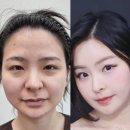 체인지업 나를 바꾸는 셀프메이크업 | 이마거상 후기 수술전부터 6개월 스토리