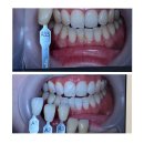 한국치과의원 | 강남레브치과 치아미백 솔직 후기 (feat. 누렁니 탈출..)