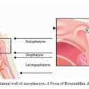 비인두암[nasopharyngeal cancer]한 줄 설명비인두에 생긴 악성 종양 이미지