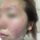 안창헌피부과의원 네이버블로그