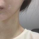 성복2로 | 용인) 수지 성복역 피부과 엠페이스 중안부 리프팅 후기