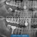 임플란트 교정 주제로 열린 2025 성인교정심포지엄 강의 참석후기