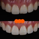 재주좋은치과의원 | [치과 탐방] 하이엔드 앞니 심미치료, 교대역 재주좋은치과의원 서초본원