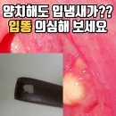 양치를 해도 입냄새가 심하다면? ‘입똥’ 편도결석 때문일 수도! 이미지