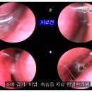 [대전 소아 한의원]겨울철 누런 콧물, 시원하게 빼주기, 배농치료 [대전 비염 한의원-월평동 한얼한의원] 이미지