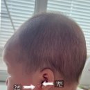 아이앤힐성형외과의원 | [내돈내산 리뷰] 남양주 아이앤힐 성형외과 80일차 아기 스킨텍(선천성 부이주) 제거 수술