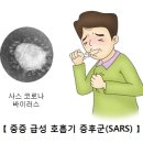 중증 급성 호흡기 증후군(Severe Acute Respiratory Syndrom)증상 이미지