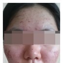 다나을한의원 | 성인여드름한의원 나한테 맞는곳에 다니면서