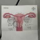 청개구리PC | 천안 복강경자궁근종수술 단일공 입원 후기