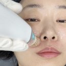 쥬베룩 5cc + 포텐자 시술, 모공 축소 청담동 피부과 꿀조합 후기 (통증,가격,효과)