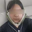 양악수술 8일차 ~ 14일차 후기 | 14일의 기적| 붓기, 통증, 음식 등 총 후기