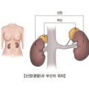 부신피질기능저하증- 에디슨병 이미지