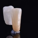 J.M치과기공소 | 치아를 잃었지만, 임플란트가 어려운 상황이라면 - 레진 접착 브릿지(Resin Bonded Bridge, RBB)