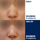 오뚝 | 칼럼] 코끝 처짐과 뭉툭한 복코 고민, 기존 필러 긁어내고 자가조직만으로 오뚝한 직반 라인 완성하기