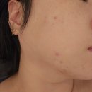 러블리여나 | 광주 봉선동 에스테틱 ' 러블리여나 ' 여드름 압출 받은 후기