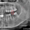 이창호치과의원 | 임플란트는 뼈이식이 꼭 필요할까?(서대문역 치과의 치조골 이식 후기)