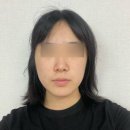 연신내약국 | 연신내역피부과 피코프락셀 - 여드름 흉터 노란 간판 모공 치료 1회차 솔직 후기 👩‍⚕️