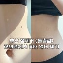 삼정한의원 | 부산 점제거, 튀어나온 돌출점 빼기, 서면 한의원에서 침으로 한 번만에 흉터없이 제거한 리뷰