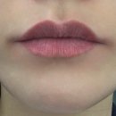 이태원의원 | 내돈내산) 이태원 입술필러 엘리엇의원 리터치 후기 및 필러붓기와 경과