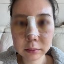 청이비인후과 | 코재수술 콧구멍짝짝이 콧대 삐뚤어짐상담병원부터 한달차 내돈내산후기 코재수술1탄