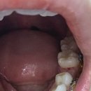 라온치과의원 | 대구 서부라온 치과 (교정후기-충치치료&amp;철사쪼으기)교정일기 6편