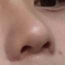 연골 | 복코 콧볼축소 연골묶기 솔직 후기