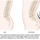 말랐는데 배만 불뚝?! 척추전만증 의심해봐야 이미지