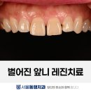 수성연합치과의원 | 벌어진 앞니를 바이오클리어로 치료한 케이스 | 대구 수성구 치과