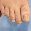 청평약국 | 오래 방치해서 노랗고 두꺼워진 발톱 관리 후기