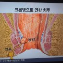 크론병으로 인한 농양,치루 이미지