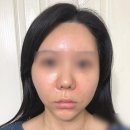 청담 피부과의원에서 꺼진 팔자 쥬베룩 볼륨으로 채우고 만족하고 온 후기