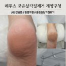계산새로 | 계산동 레푸스 굳은살 각질제거 1회관리 변화 후기