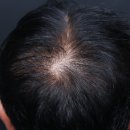 계수초등학교 | 시흥탈모병원 후기｜60대 정수리 탈모 관리 후 달라진 점 (전후비교)