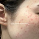 알렉스 | 부산 피부과 알렉스토닝 후기 주근깨 없애기 내돈내산