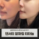 알파 사우나 | 길음역피부과, 덴서티알파팁 600샷 티타늄리프팅40KJ 찐 후기