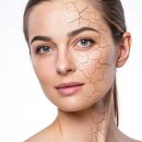 리즈멍 | 대구칠곡피부과 스킨부스터 건조탄력관리 리쥬란&amp;리즈네 통증/멍/내돈내산 후기