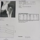 보건소 골밀도 검사후기 이미지